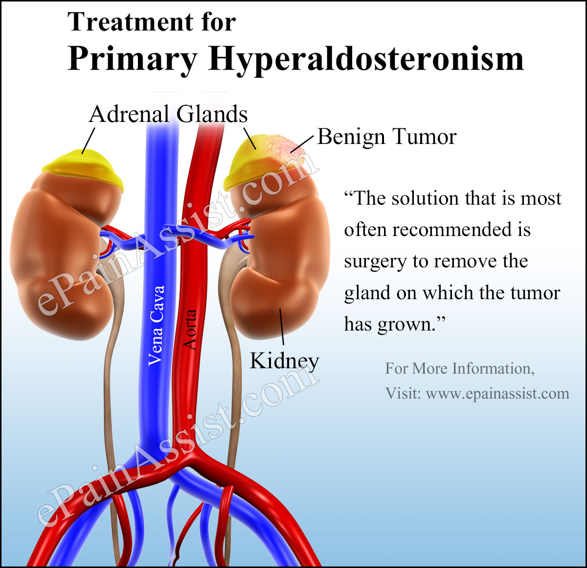 Treatment for Primary Hyperaldosteronism or Primary Aldosteronism Treatment for Primary Hyperaldosteronism or Primary Aldosteronism