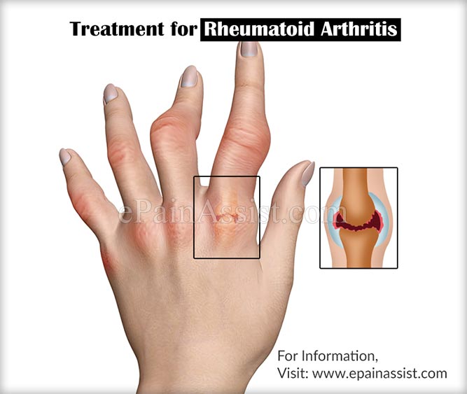 Treatment for Rheumatoid Arthritis (Chronic Inflammation of Joints)