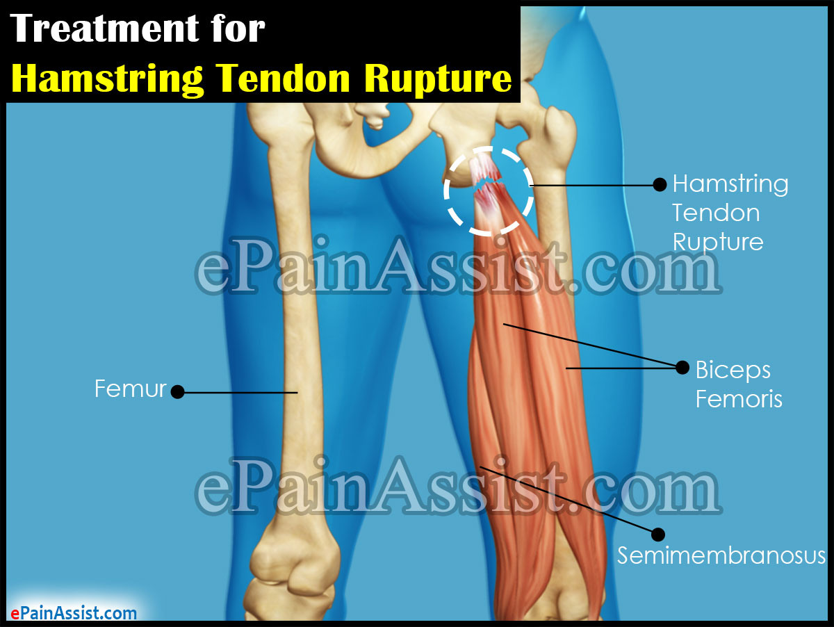 Treatment for Hamstring Tendon Rupture Treatment for Hamstring Tendon Rupture
