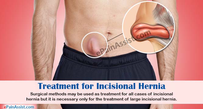 Treatment for Incisional Hernia