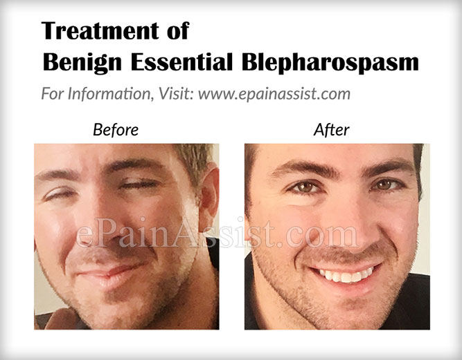 Treatment of Benign Essential Blepharospasm