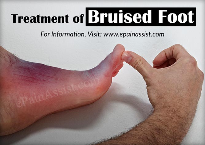 Treatment of Bruised Foot