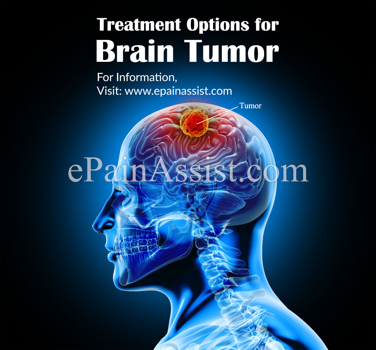 Treatment Options for Brain Tumor Treatment Options for Brain Tumor