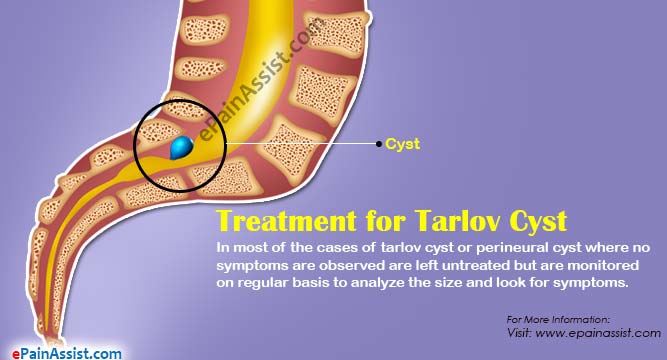 Treatment for Tarlov Cyst or Perineural Cyst