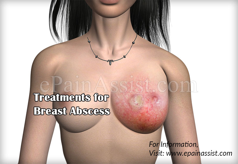 Treatments for Breast Abscess