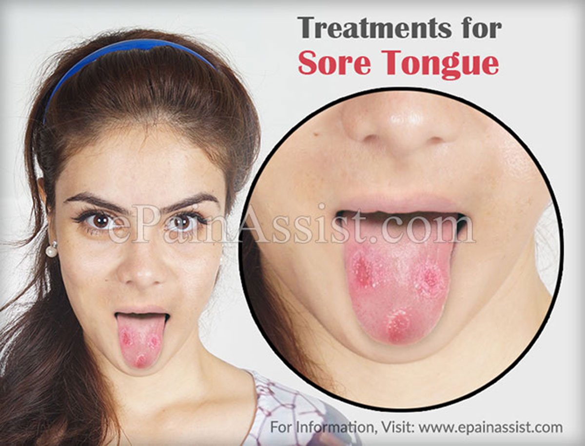 Treatments for Sore Tongue