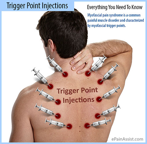 Trigger Point Injections: Everything You Need To Know