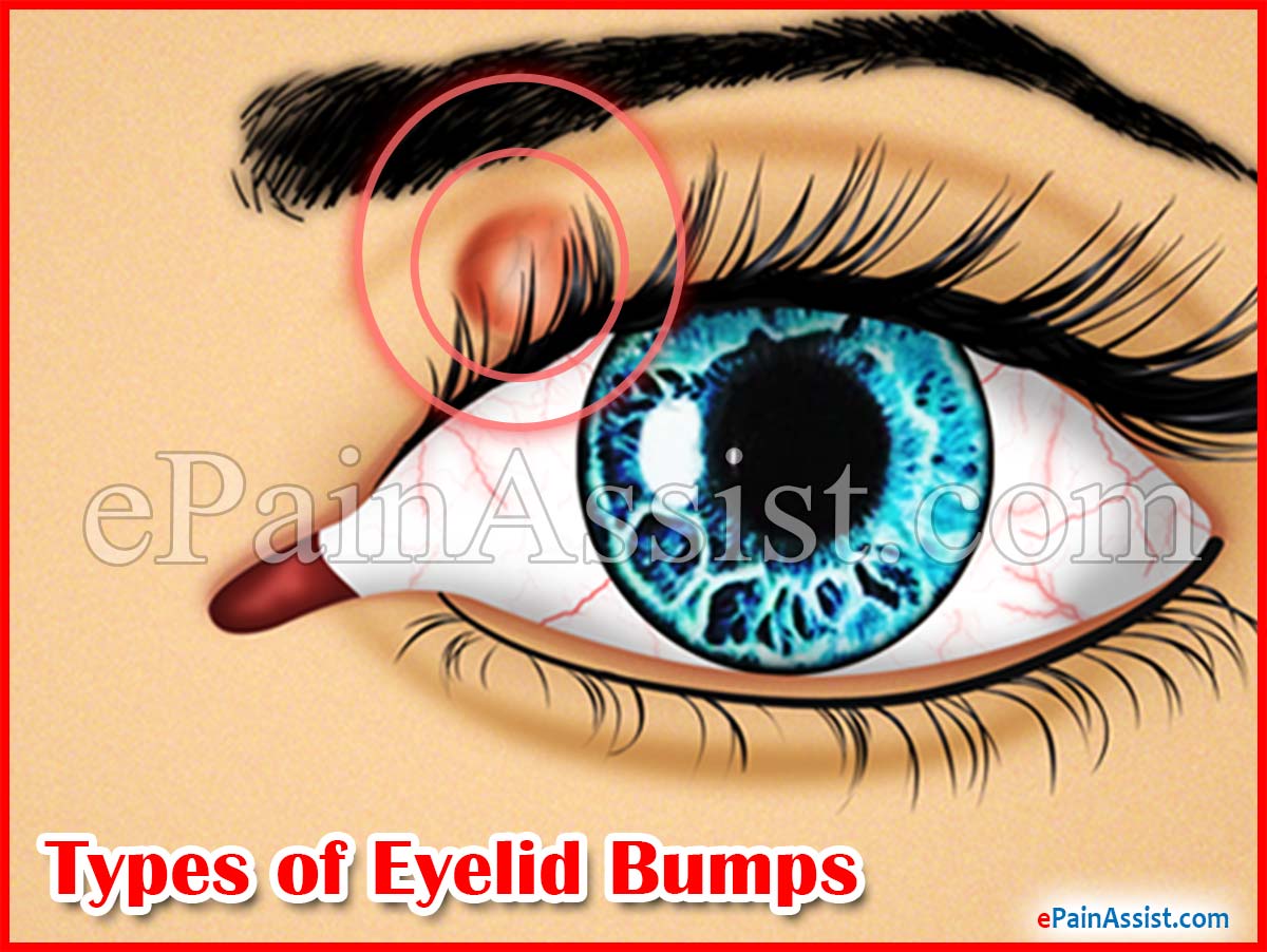 Types of Eyelid Bumps Types of Eyelid Bumps
