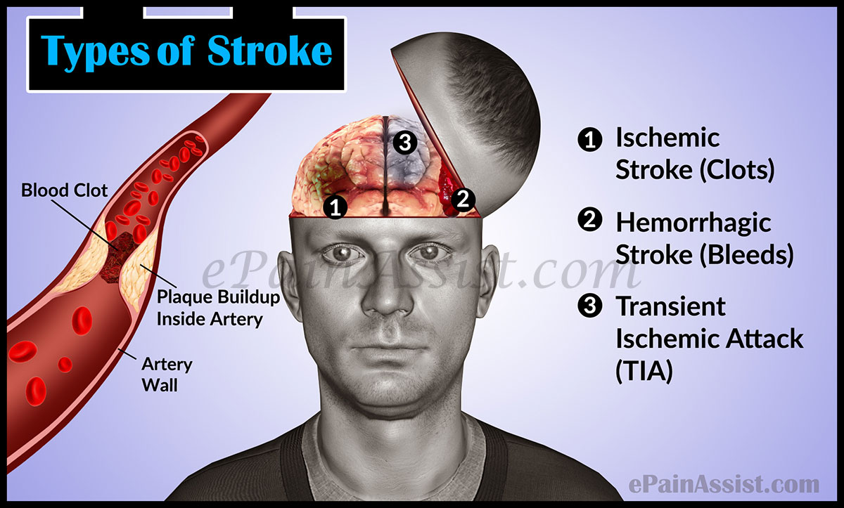 Types of Stroke: Ischemic Stroke, Hemorrhagic Stroke, TIA Types of Stroke: Ischemic Stroke, Hemorrhagic Stroke, TIA