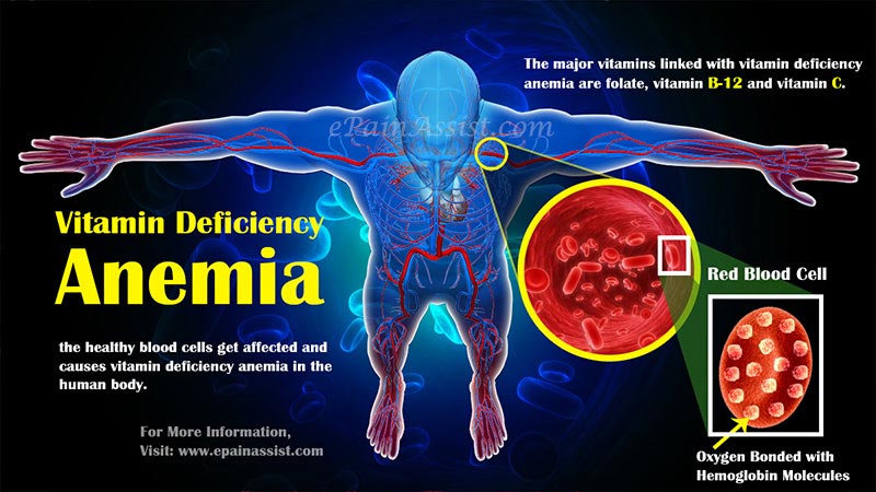 Vitamin Deficiency Anemia: Symptoms, Causes, Treatment