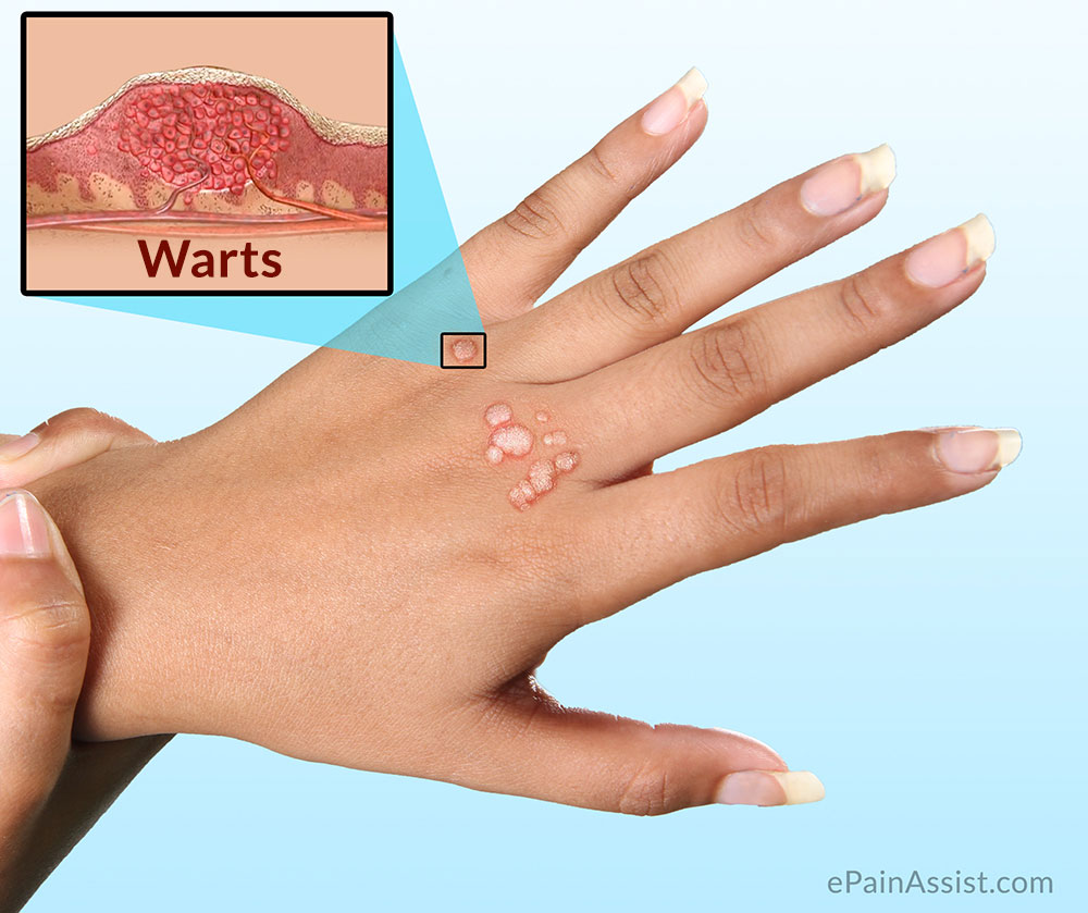 Warts|Causes|Symptoms|Investigations|Treatment ...