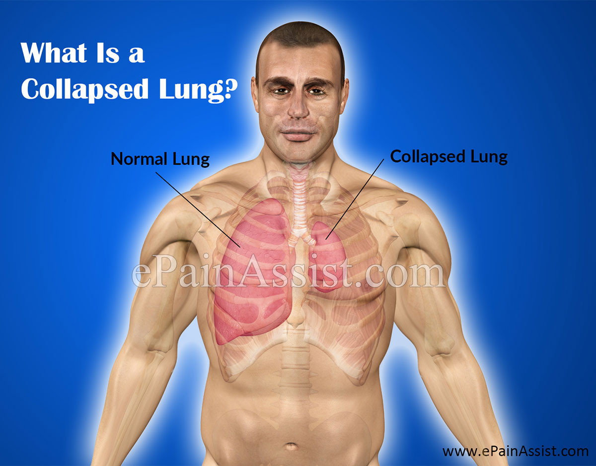What Is a Collapsed Lung or Pneumothorax?