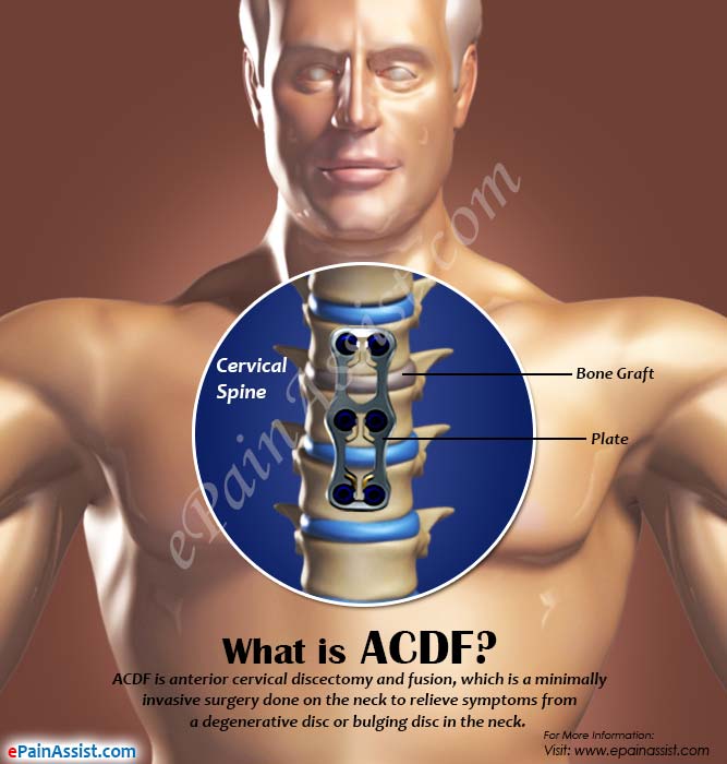 What is ACDF?