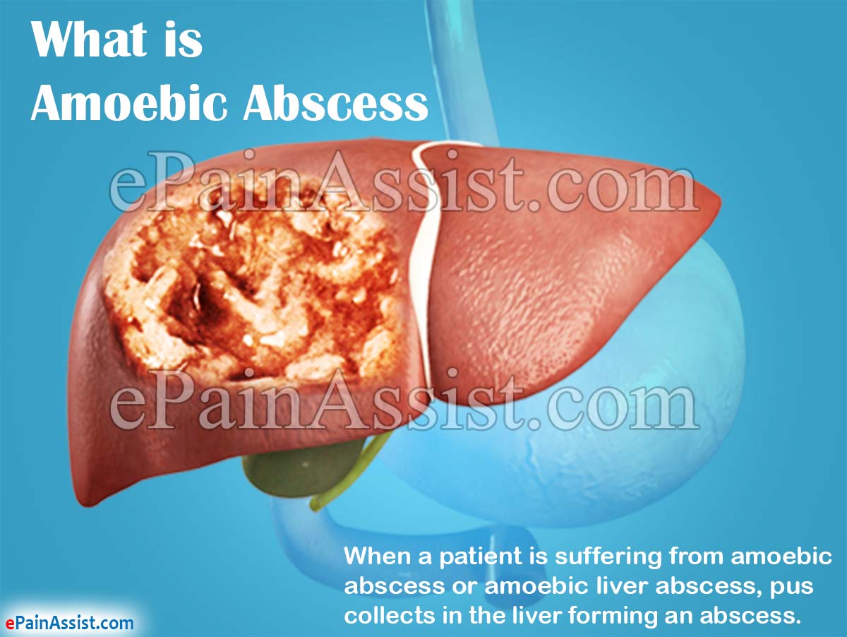 What is Amoebic Abscess or Amoebic Liver Abscess?