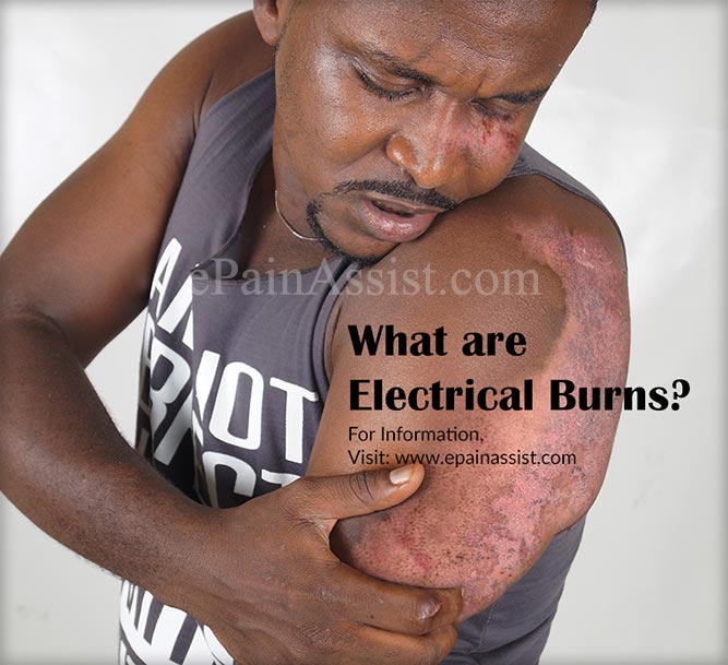 What are Electrical Burns?