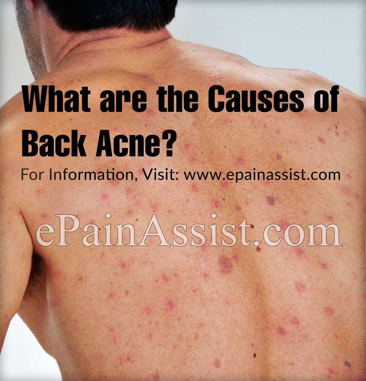 What are the Causes of Back Acne? What are the Causes of Back Acne?