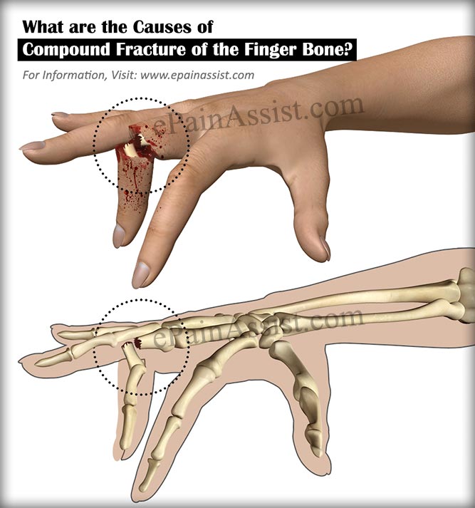 What are the Causes of Compound Fracture of the Finger Bone?