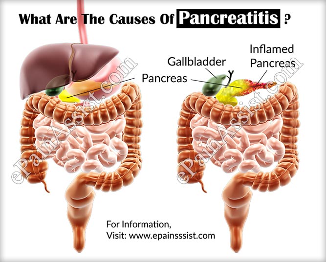 What Are The Causes Of Pancreatitis?