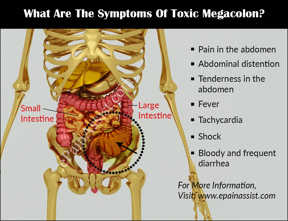 Toxic Megacolon Treatment Prognosis Causes Symptoms Diagnosis Toxic Megacolon Treatment Prognosis Causes Symptoms Diagnosis