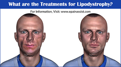 What are the Treatments for Lipodystrophy?