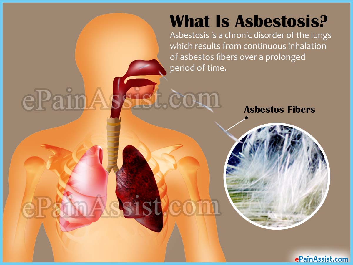 What Is Asbestosis? What Is Asbestosis?
