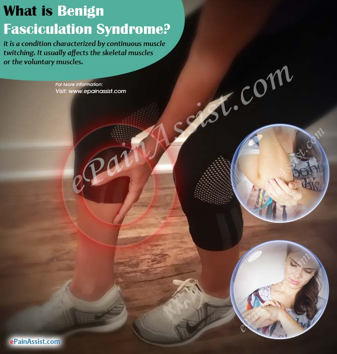 What is Benign Fasciculation Syndrome?