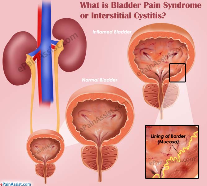 What is Bladder Pain Syndrome or Interstitial Cystitis?