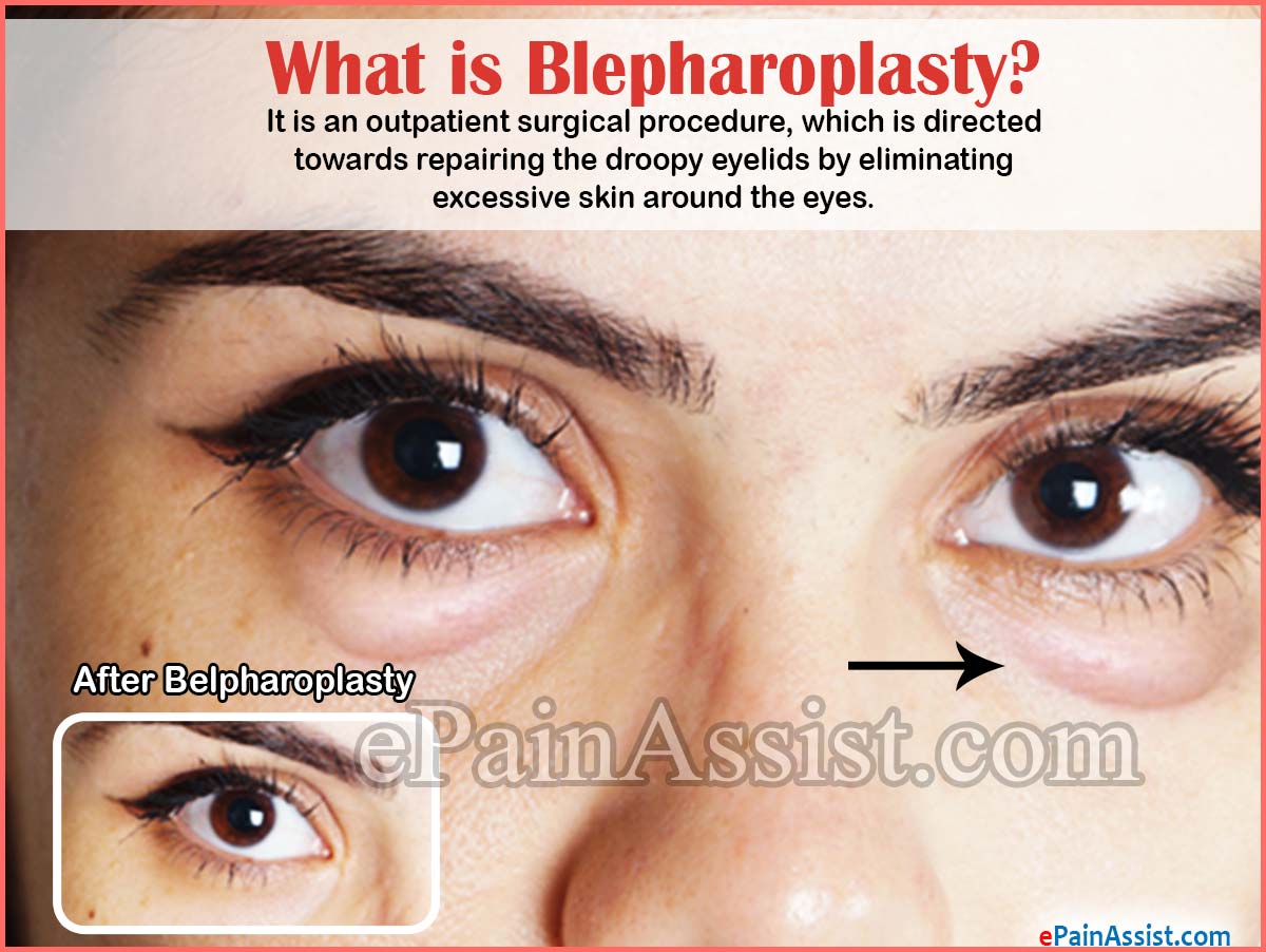 What is Blepharoplasty?