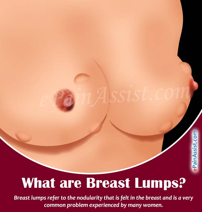 What are Breast Lumps?