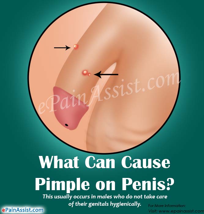 What Can Cause Pimple on Penis?