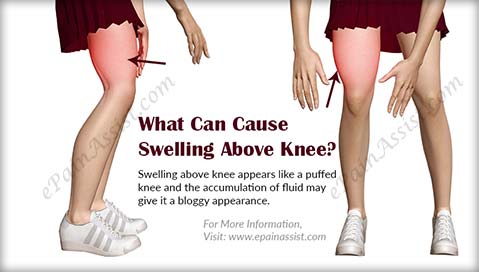 What Can Cause Swelling Above Knee?