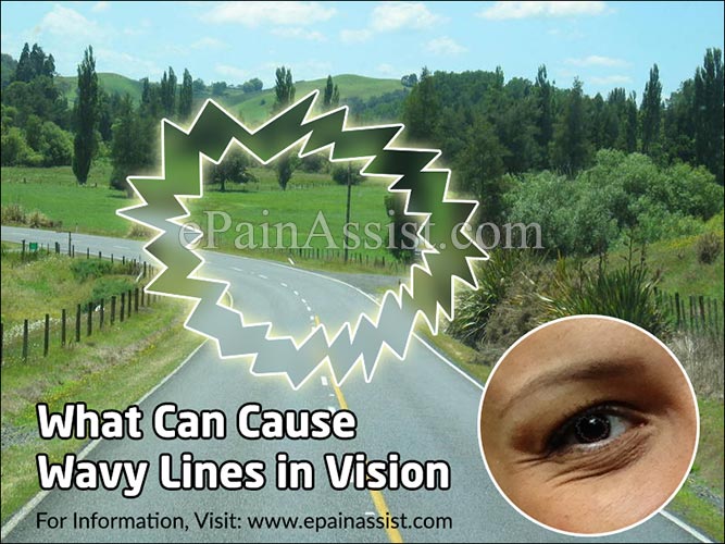 What Can Cause Wavy Lines in Vision?