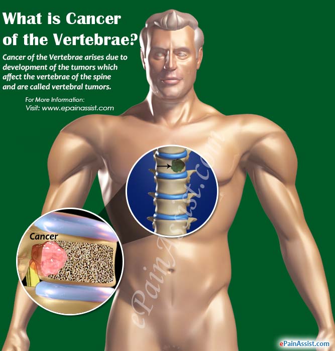 What is Cancer of the Vertebrae? What is Cancer of the Vertebrae?