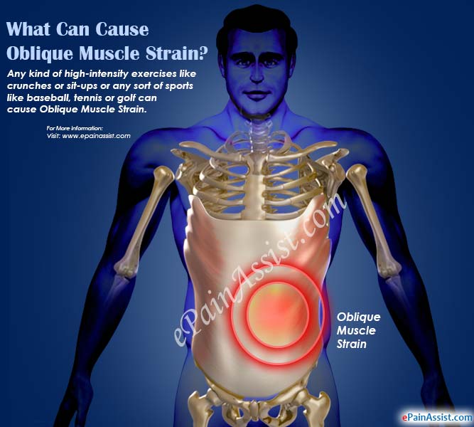 What Can Cause Oblique Muscle Strain?