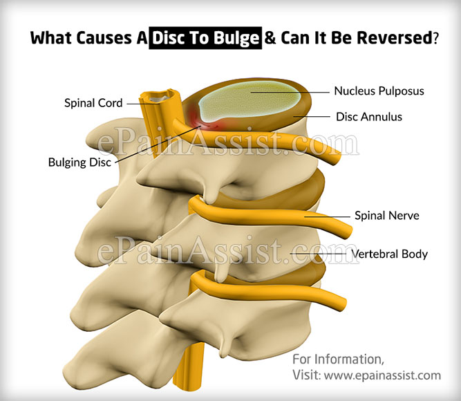 What Causes A Disc To Bulge & Can It Be Reversed?