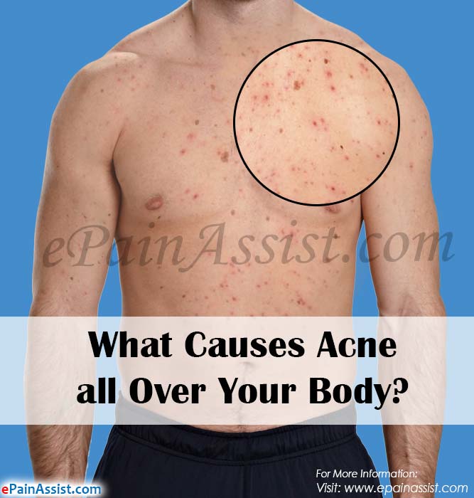 What Causes Acne all Over Your Body?