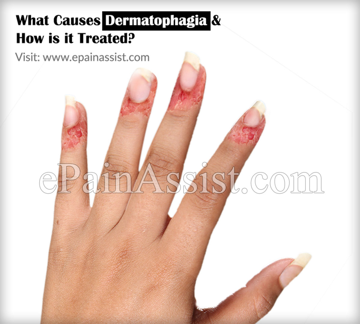 mi okozza a Dermatophagia-t hogyan kezelik?