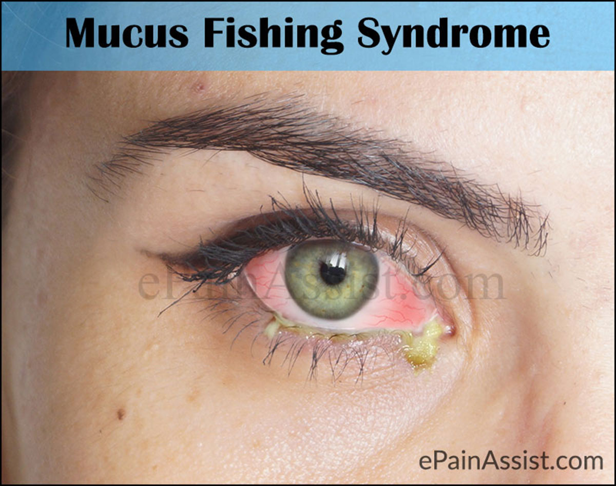 What is Mucus Fishing Syndrome? What is Mucus Fishing Syndrome?