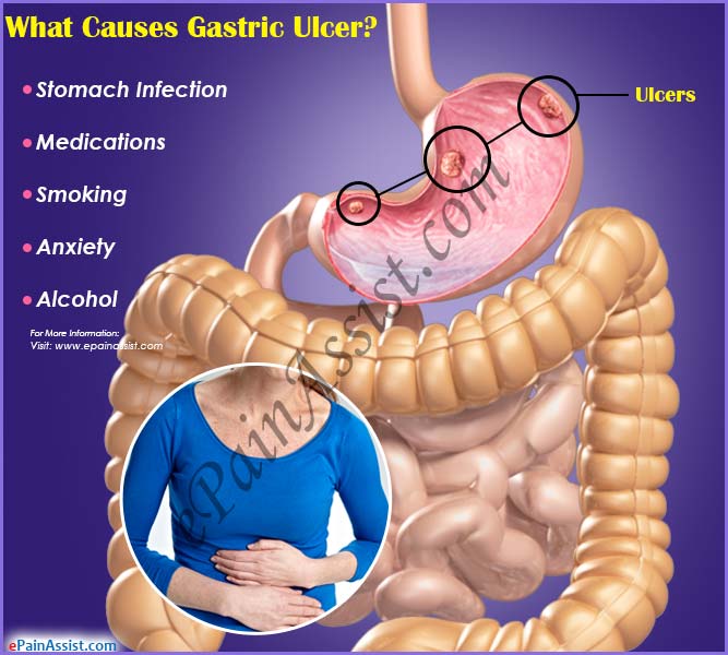 What Causes Gastric Ulcer?