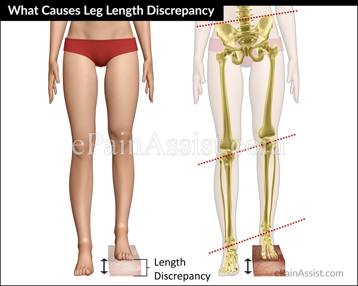 What Causes Leg Length Discrepancy (LLD)? What Causes Leg Length Discrepancy (LLD)?