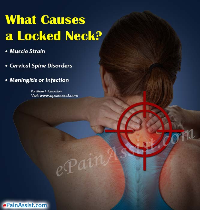 What Causes a Locked Neck?