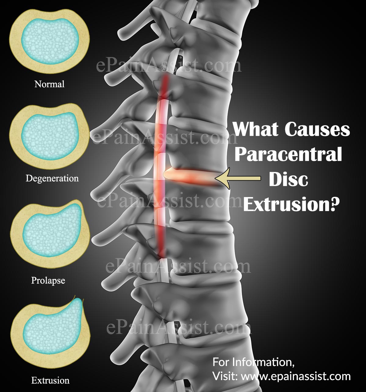 What Causes Paracentral Disc Extrusion?