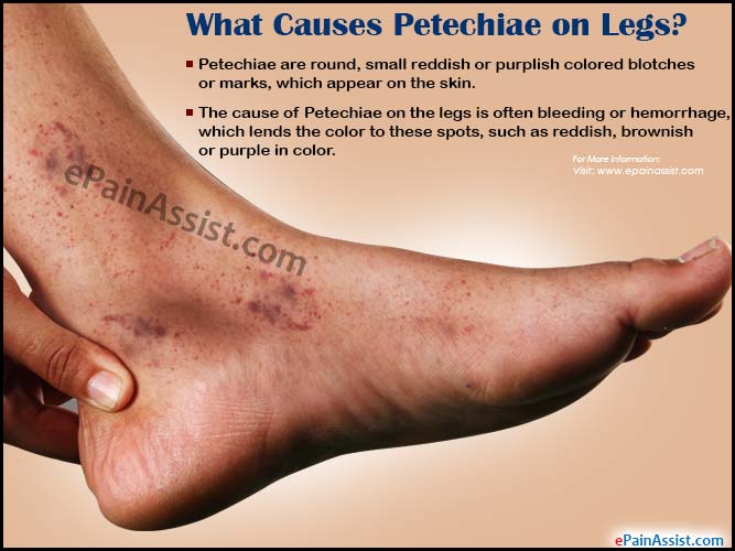 What Causes Petechiae on Legs?