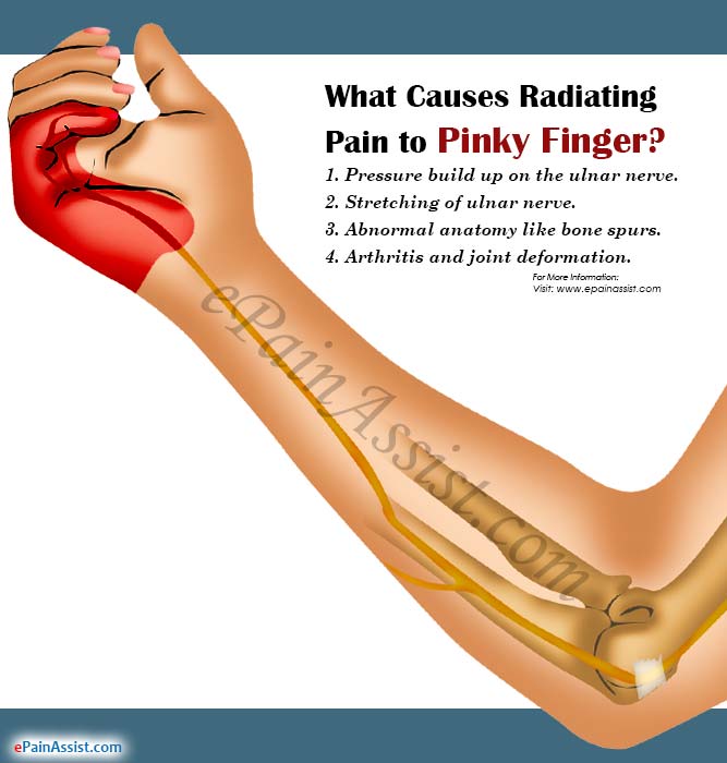 What Causes Radiating Pain to Pinky Finger?