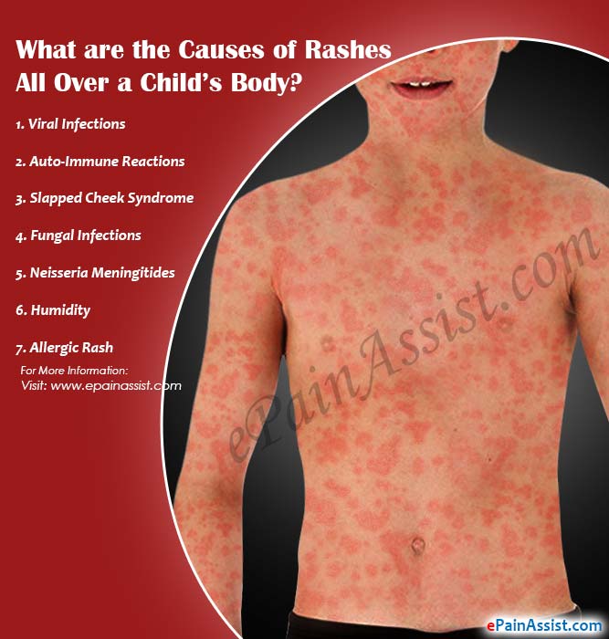 What are the Causes of Rashes All Over a Child's Body?