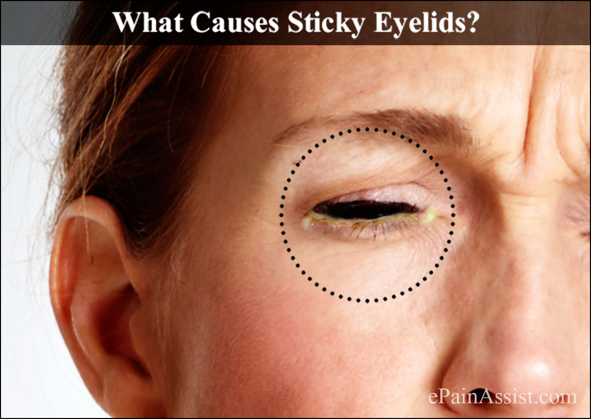 What Causes Sticky Eyelids & How is it Treated?