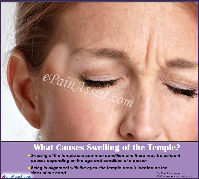Swollen Temples Headache Headache Swollen Temples Headache Headache
