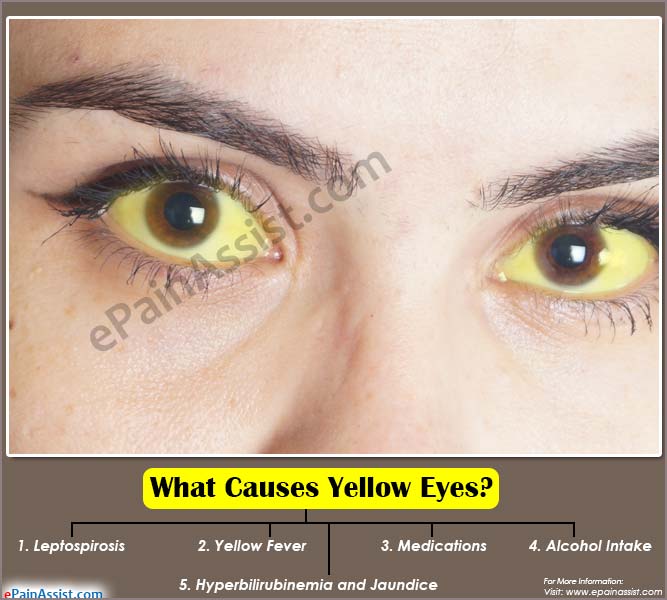 What Causes Yellow Eyes?