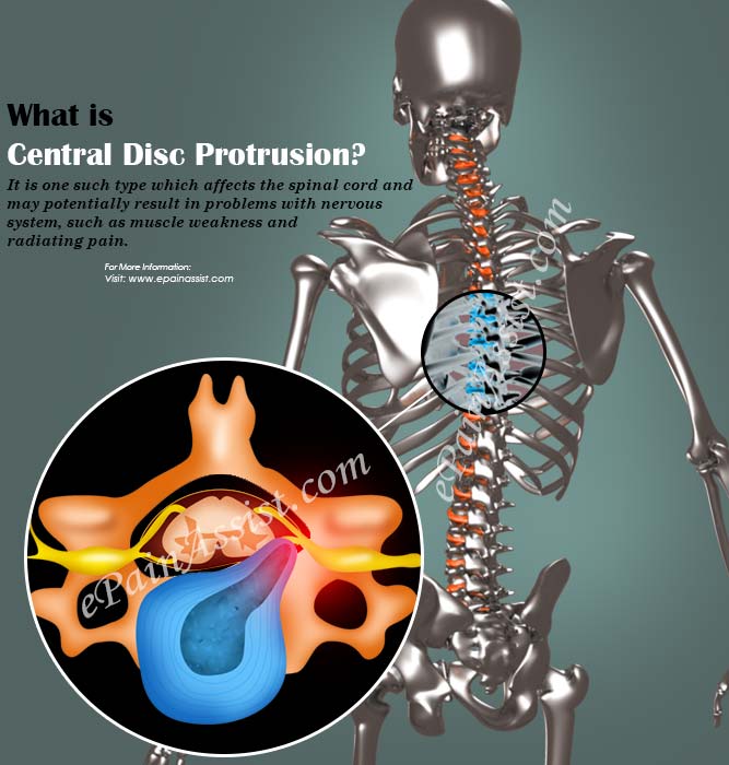 Central Disc Protrusion|Causes|Symptoms|Treatment