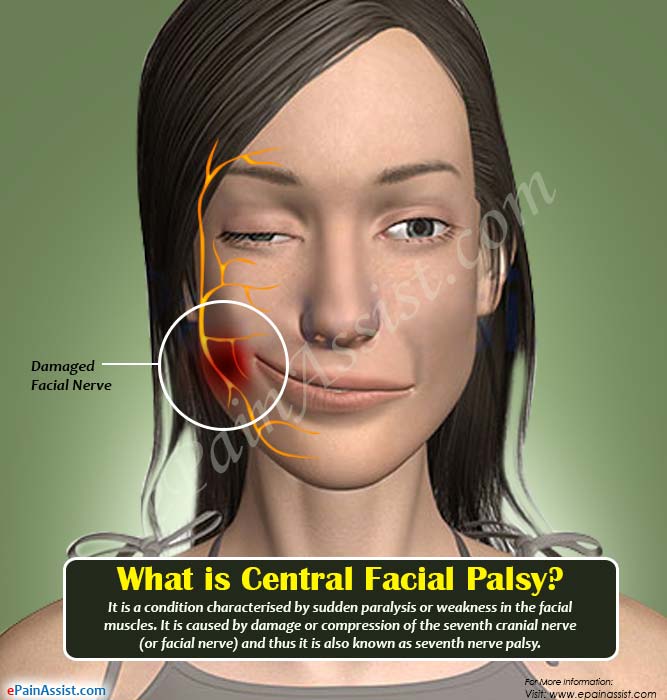 What is Central Facial Palsy?